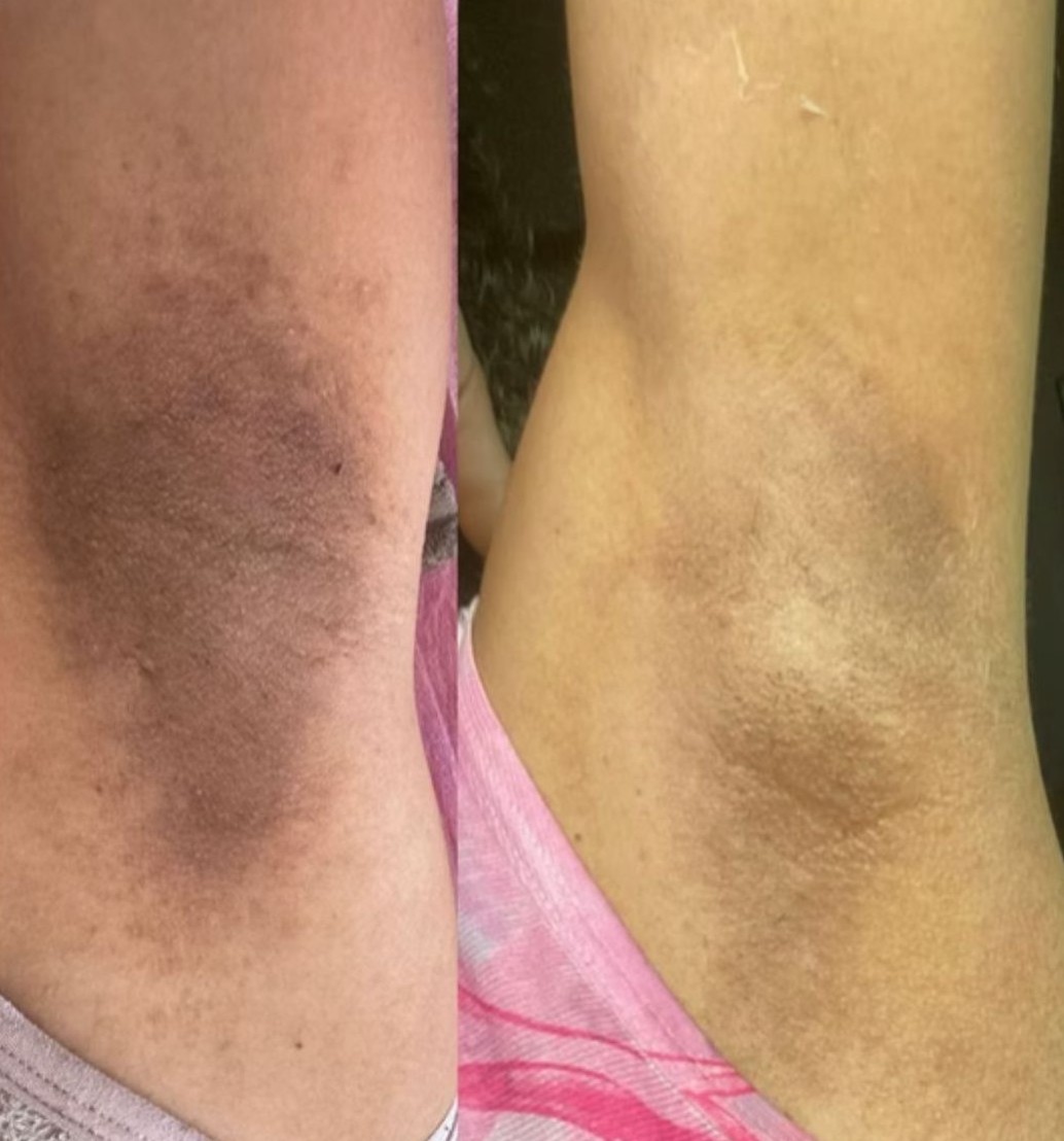 Antes e depois — Axilas renovadas